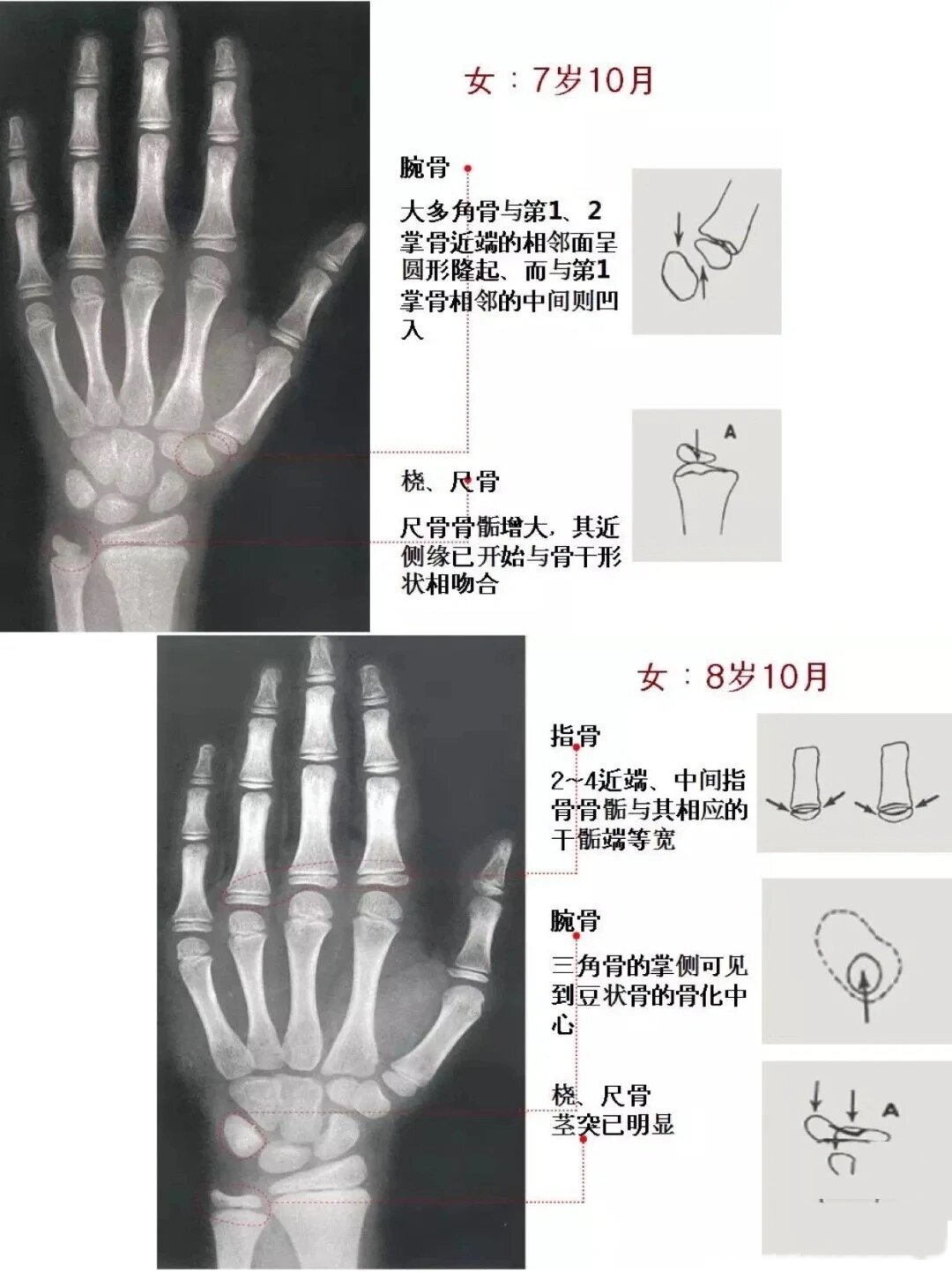 儿童骨龄图谱手腕图片