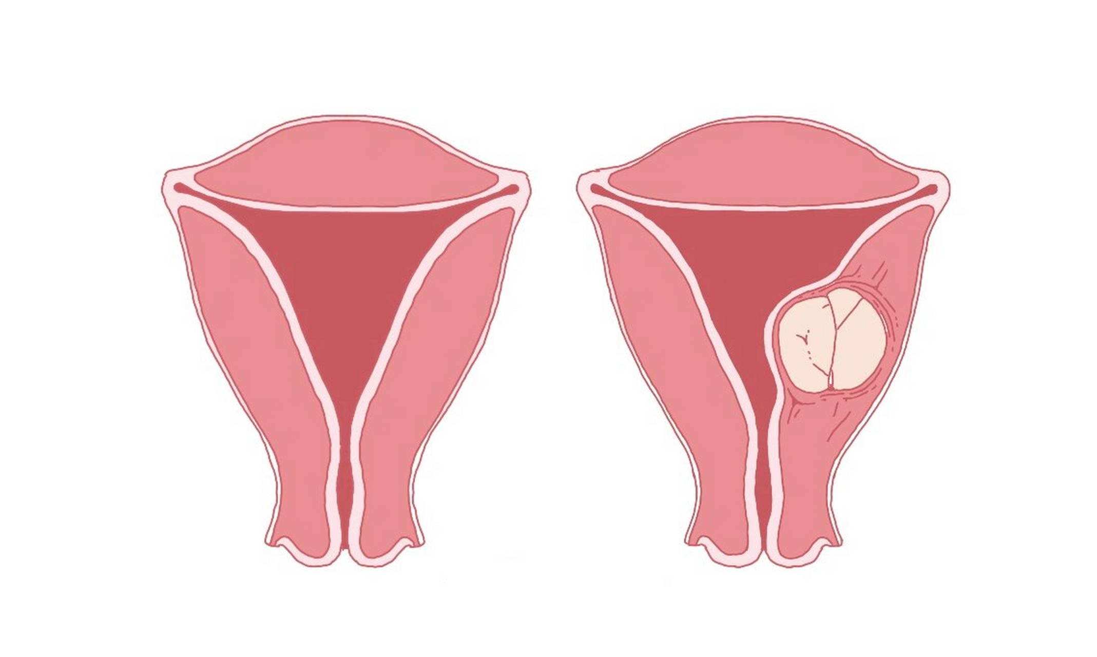 医学插画练习1-子宫肌瘤  学习中,欠了很多作业,慢慢还