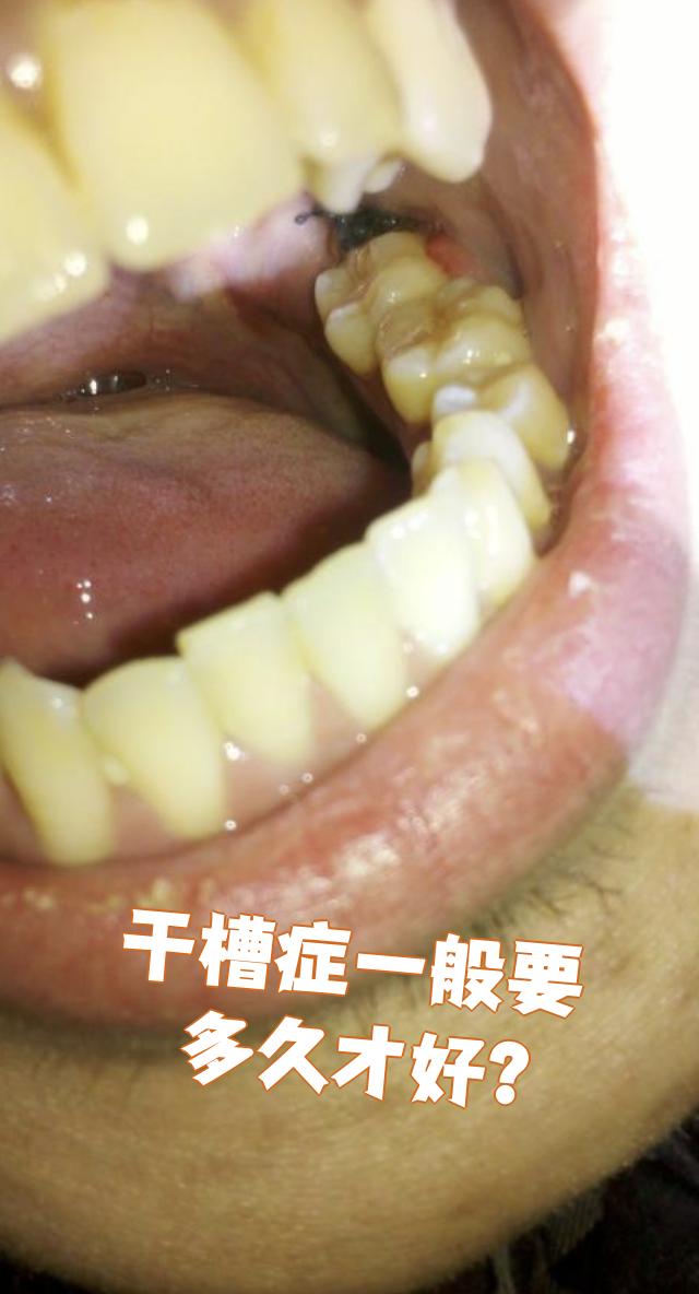 干槽症通常需要1~2周才能基本恢复