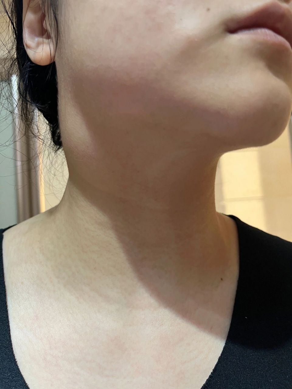 颈部肿块两年半突然变大了 不知道从什么时候起右侧脖子上摸着有个小