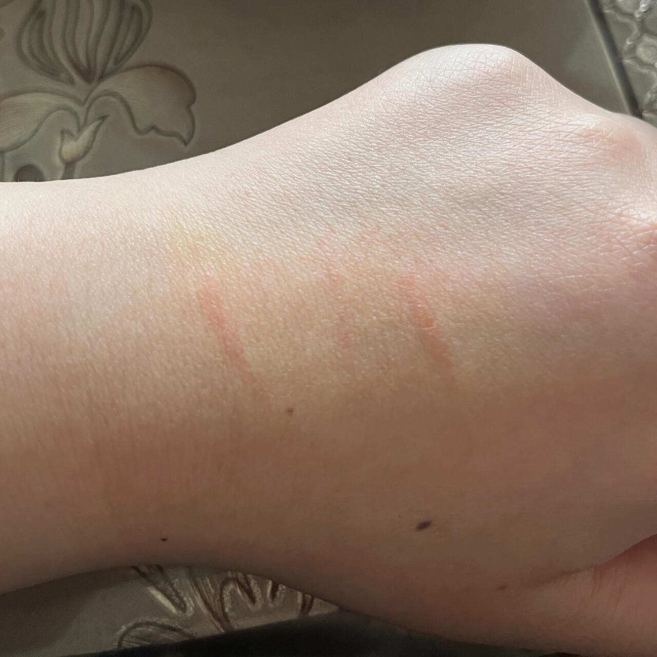 被小狗挠了 纠结了下还是去打疫苗了 抓伤程度见图二 当事狗在图三(已