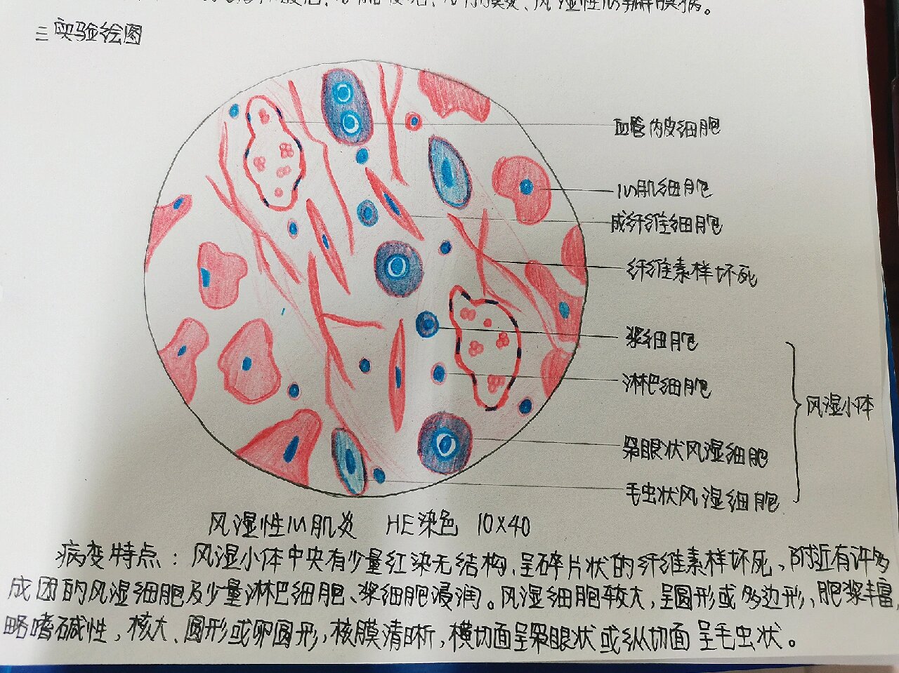 风湿性心肌炎 风湿性心肌炎红蓝铅笔手绘图 特征:风湿小体,毛虫样风湿