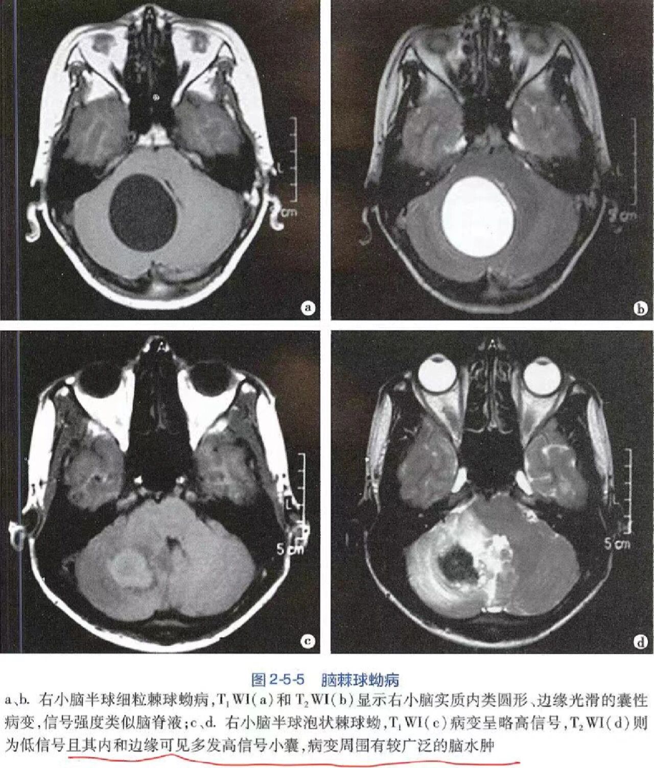 泡球蚴病图片