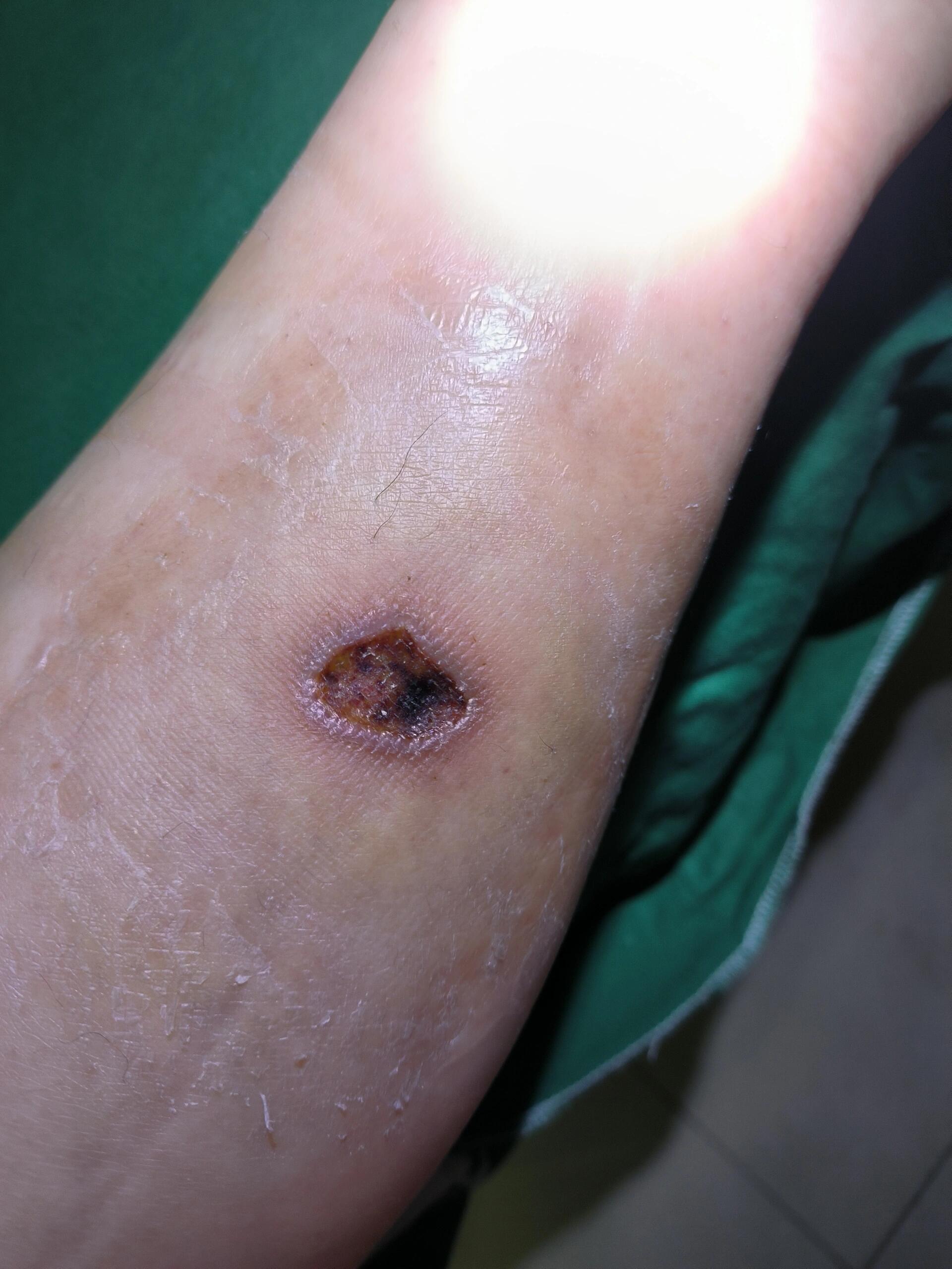 烫伤,结痂 烫伤将近一个月,伤口感染了,去医院清创,这两天结痂了