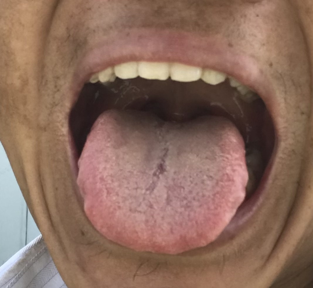 这两样泡水喝改善脾虚齿痕舌