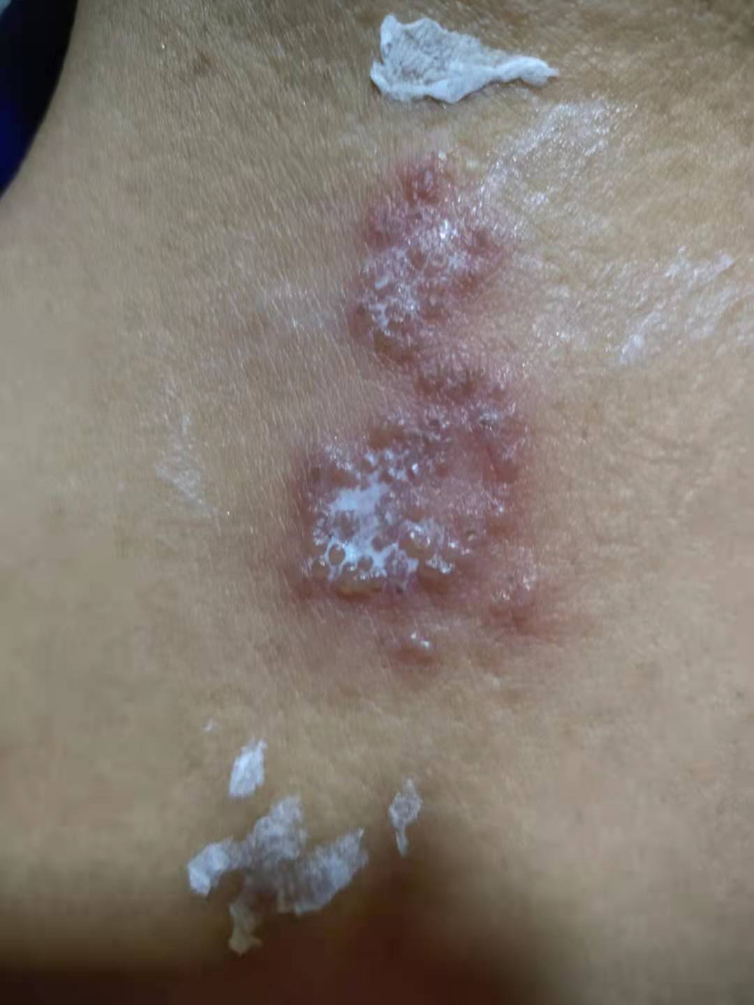 带状疱疹前期不重视，小心形成后遗神经痛，中医解毒止痛，效果好！
