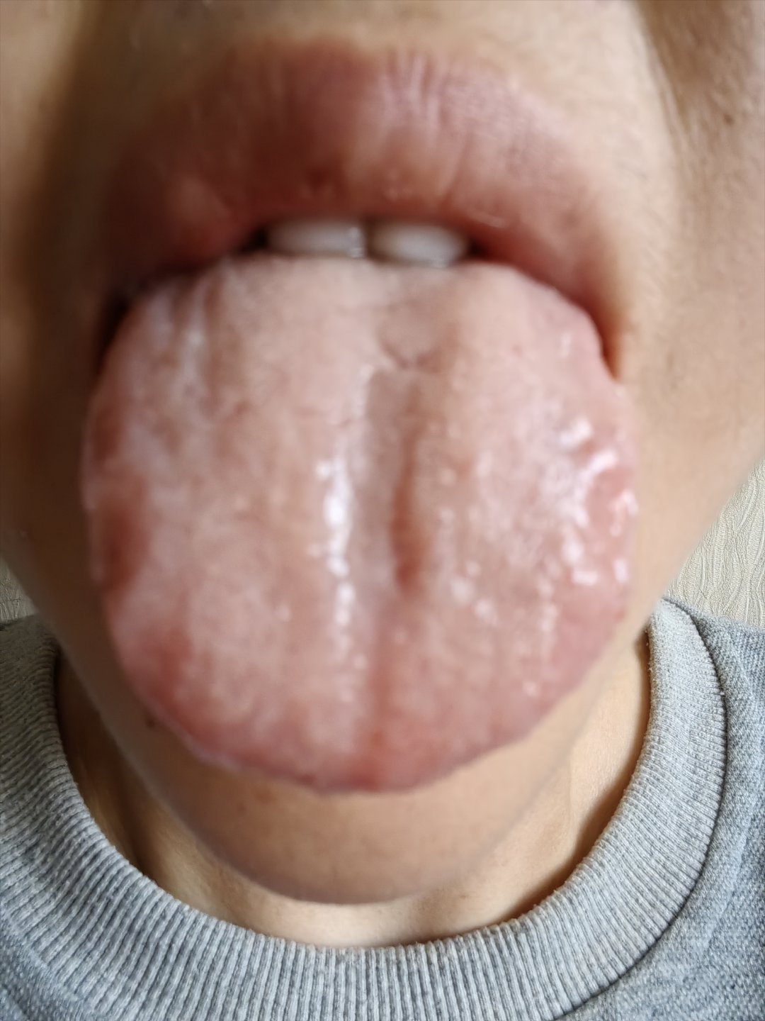 齿痕舌，肝郁脾虚了万病来找，中医教你一招，疏肝健脾，消万病