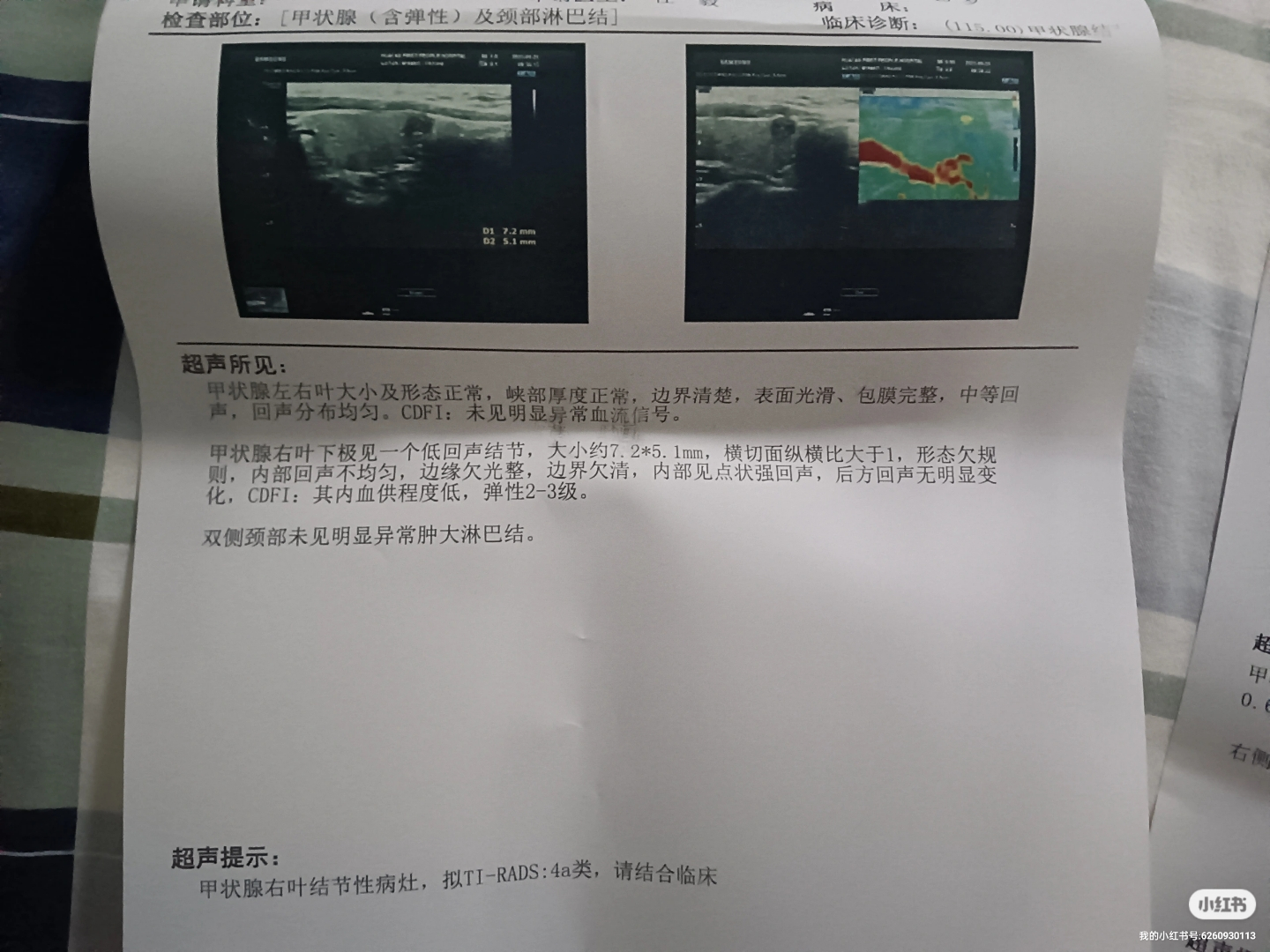 甲状腺结节4a伴有粗大钙化，患者纠结不知如何是好，医生给出建议