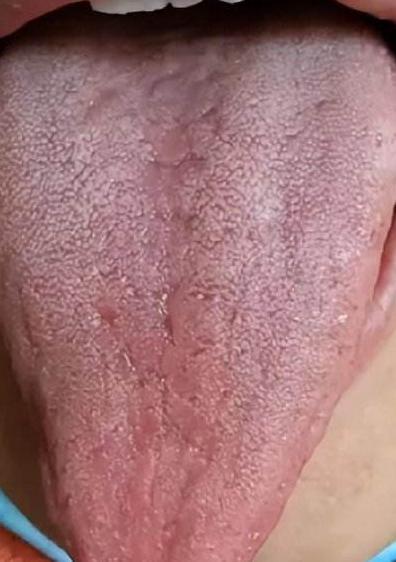 舌头火辣辣得疼 劝你少吃5种食物 越吃舌头疼得越厉害