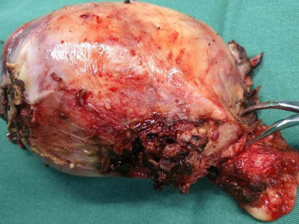 48岁男子肺部肿瘤8cm，后来肿瘤消失，他的办法人人可学