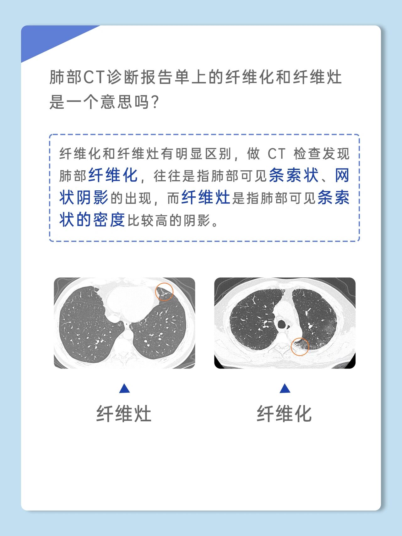 纤维化灶图片