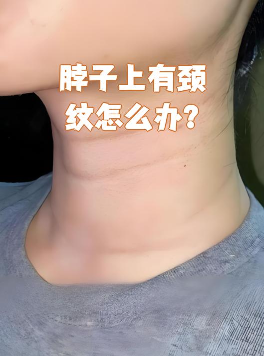 脖子为什么有颈纹 脖子为什么有颈纹