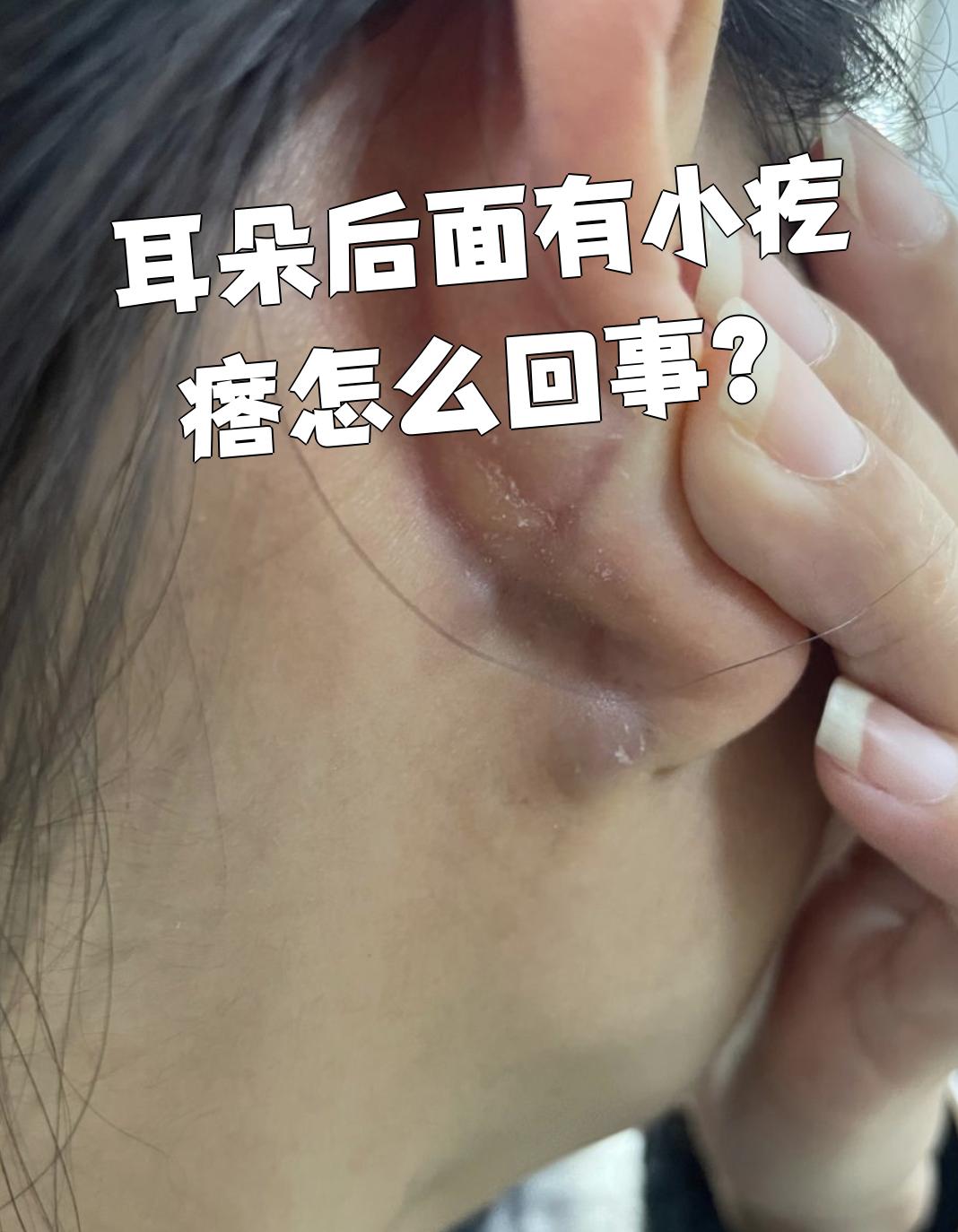 耳朵后面长小疙瘩常见原因有痤疮,皮脂腺囊肿和毛囊炎,具体是这样的