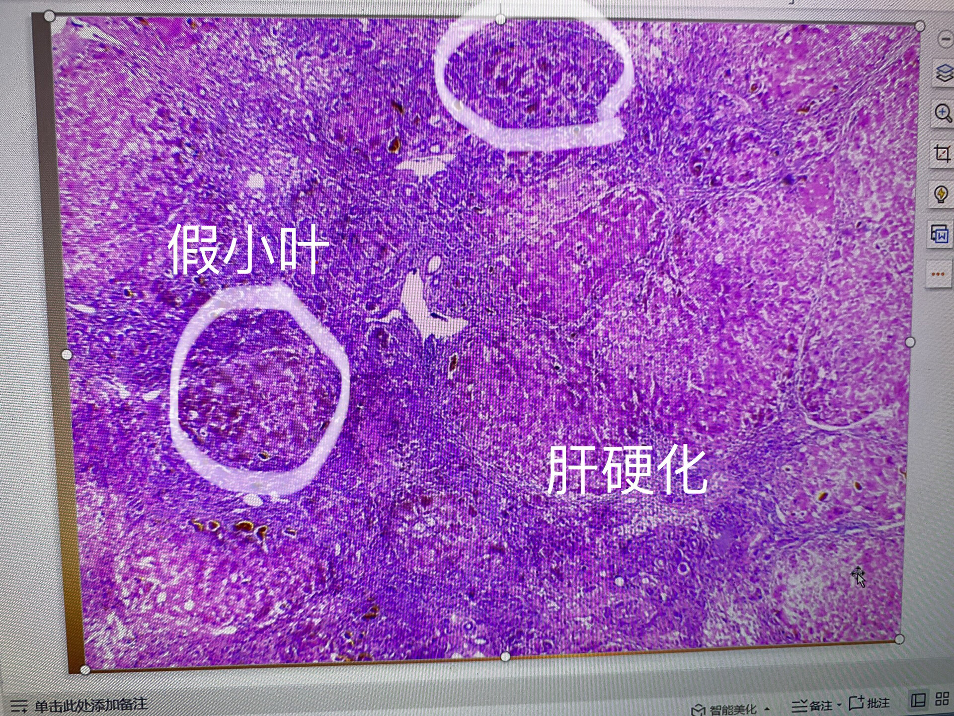 槟榔肝病理切片图片