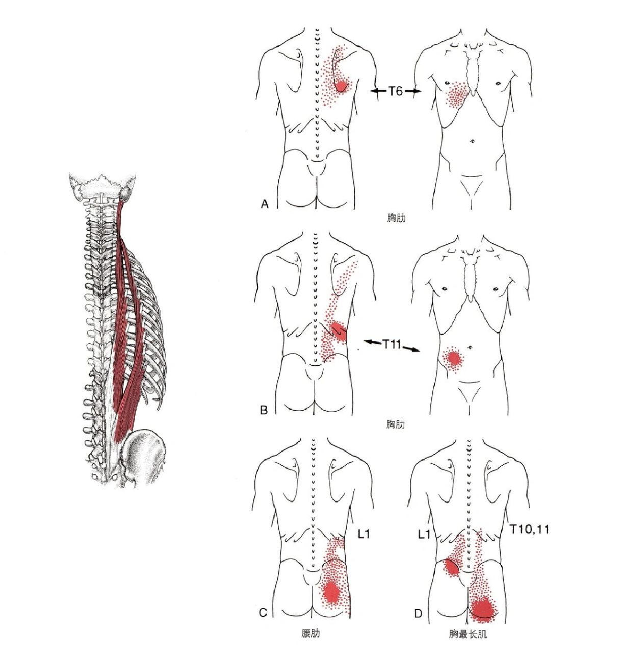 肌筋膜疼痛及功能障碍(竖脊肌和横突棘肌)  胸腰椎旁肌的触发点是后背