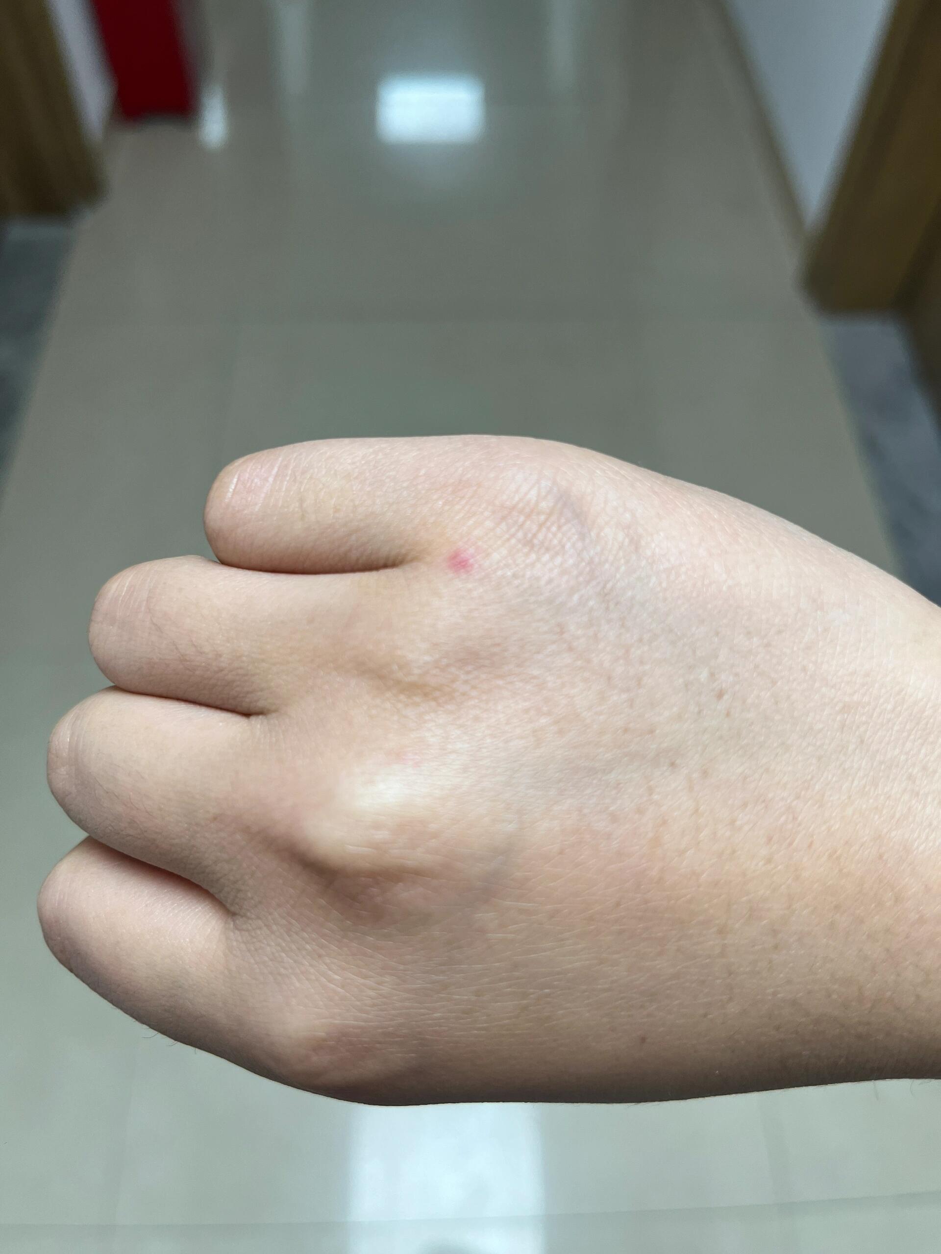 手上长红点 想问一下这个是啥,一到热天就长,不痛不痒,没有凸起