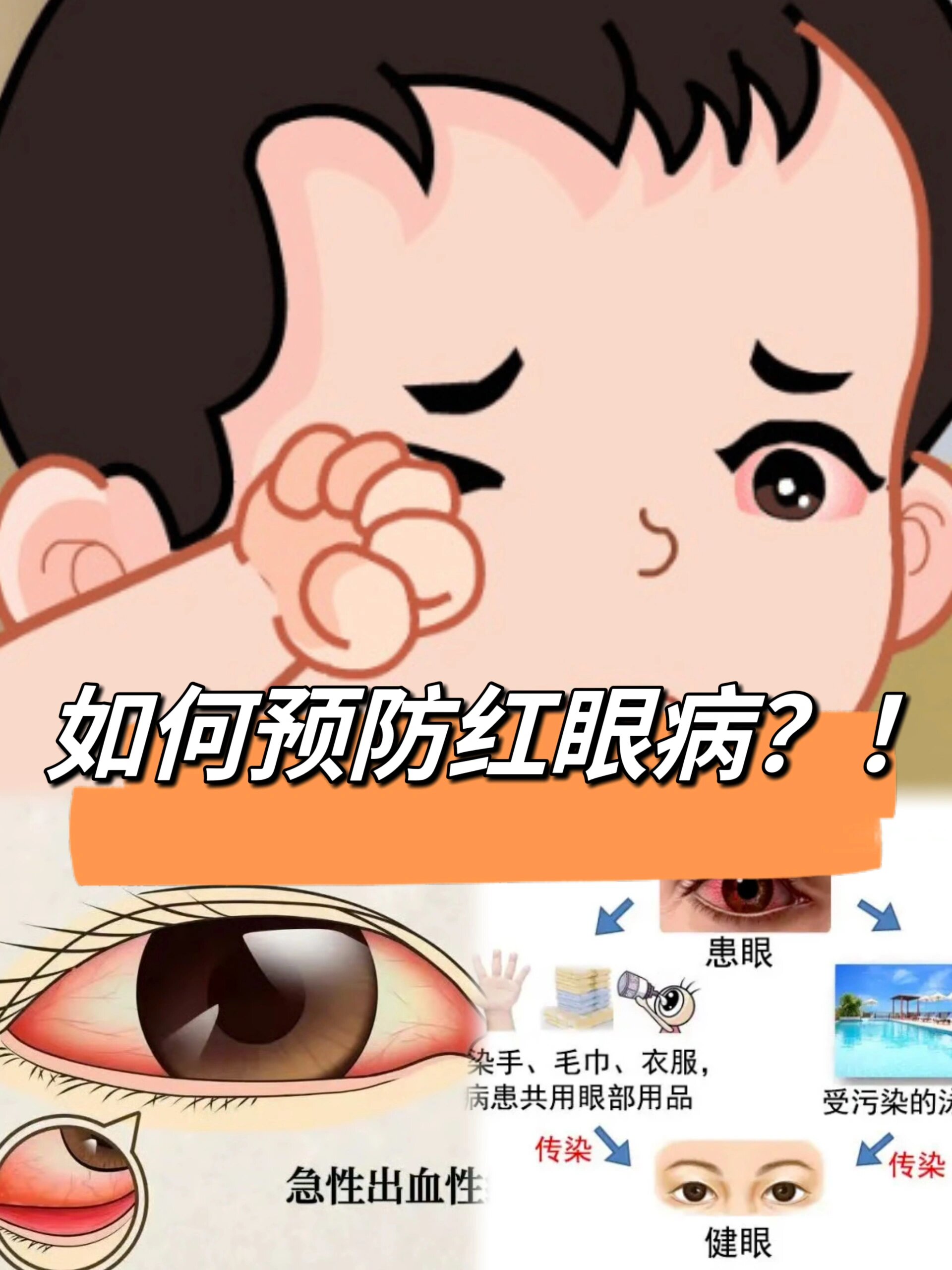 红眼病看一眼就传染?宝宝在幼儿园如何预防