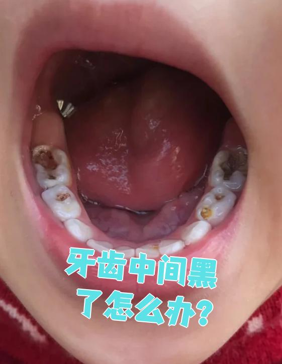 牙齿中间黑了怎么办?