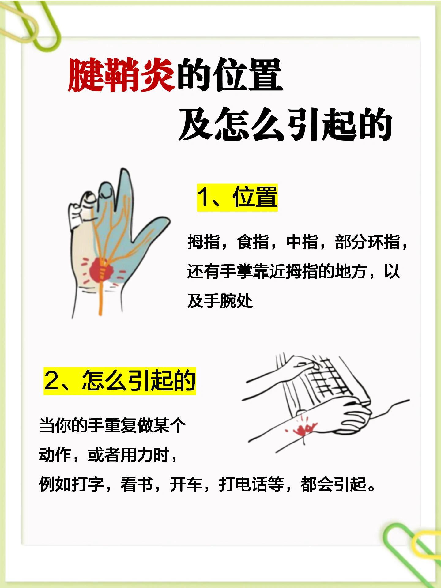 预防 1,注意休息 2,正确握鼠标 3,腱鞘操 - 治疗 贴傅豫堂膏药,椅次