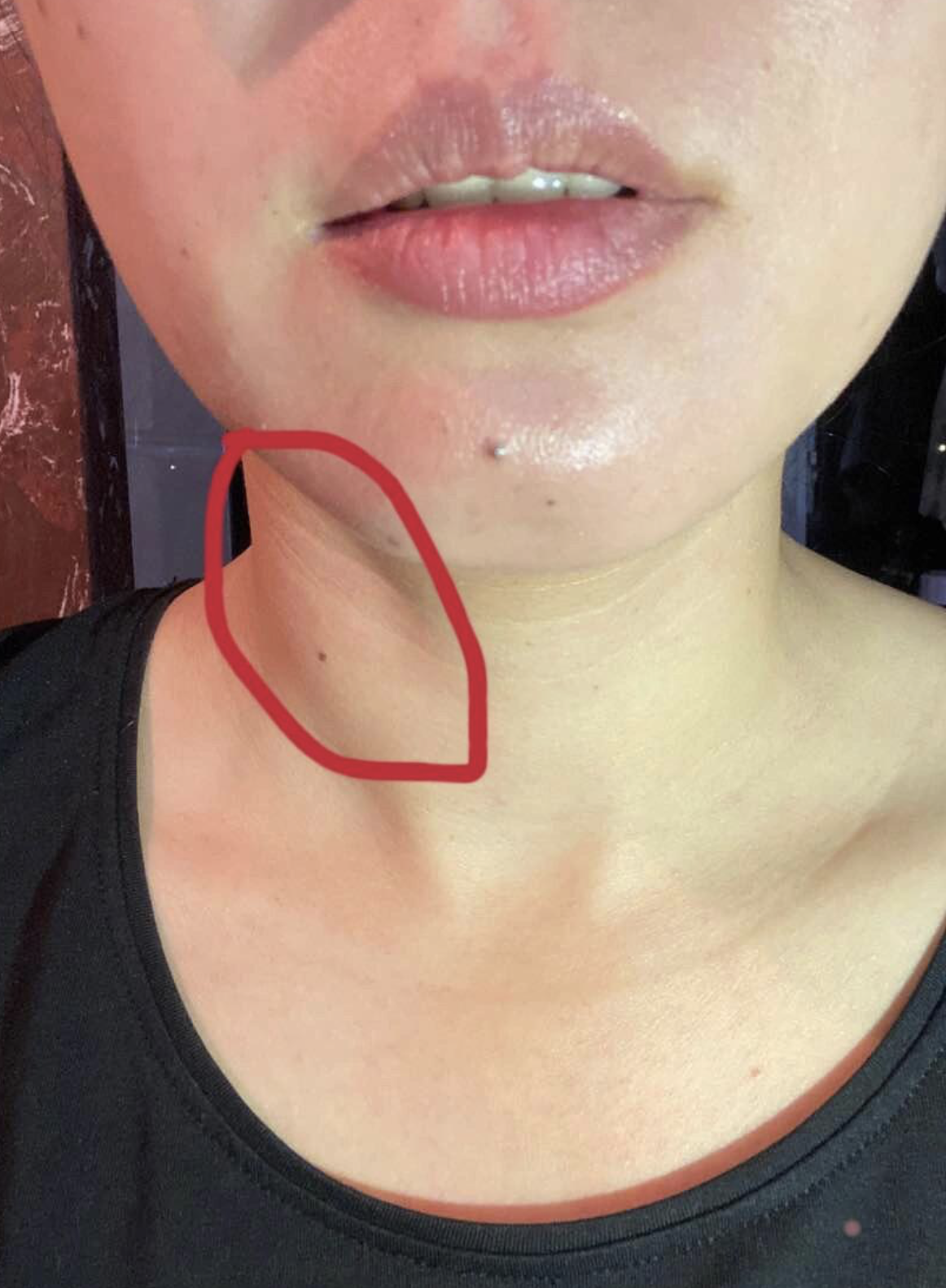 甲状腺囊肿:囊肿长在甲状腺一侧时,会在颈部形成圆形肿块