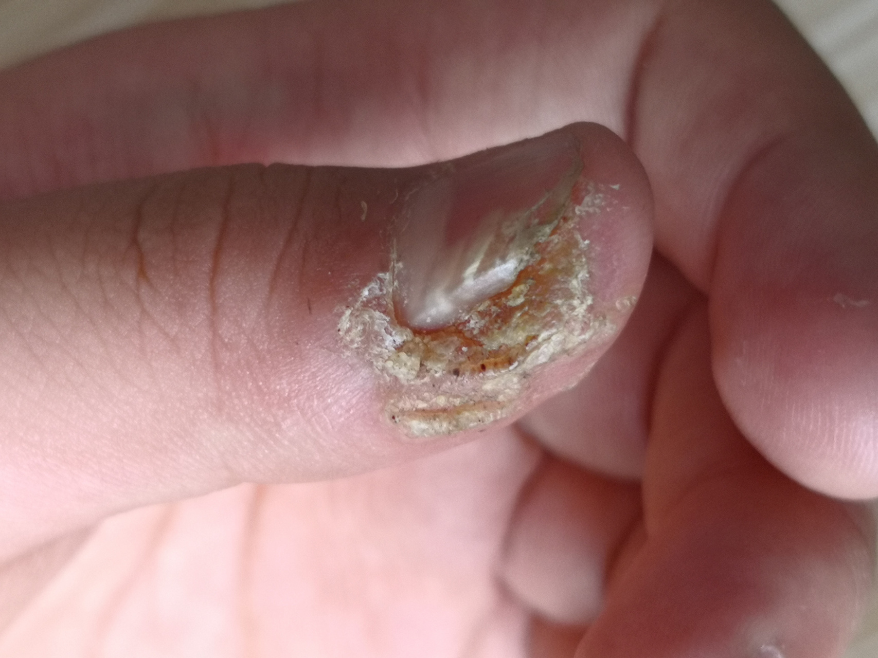 甲周疣.可以使用药物涂擦配合理疗治疗.