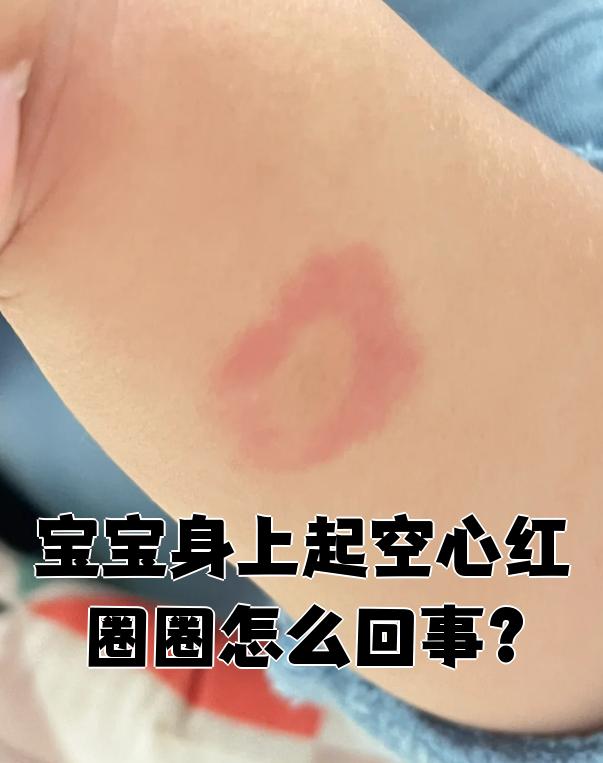 宝宝身上出现空心红圈圈,可能是体癣,离心性环状红斑或荨麻疹引颇的