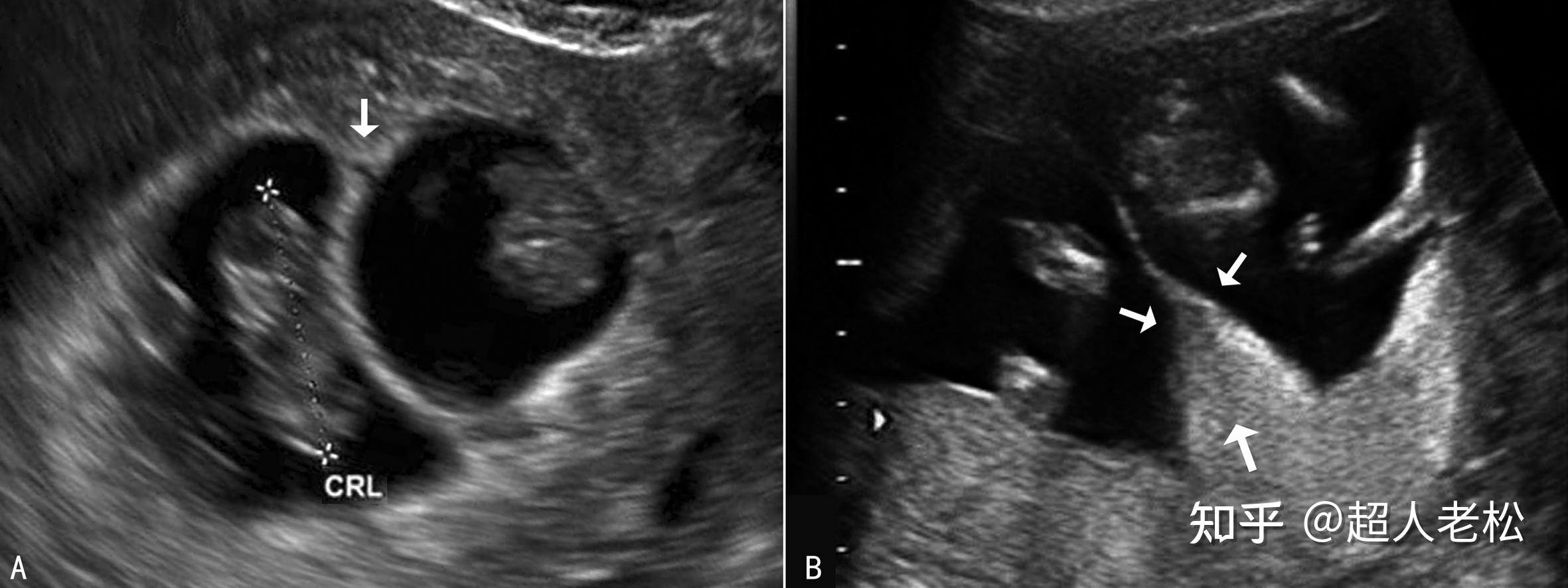 明明白白做超声225不同类型多胎妊娠超声检查