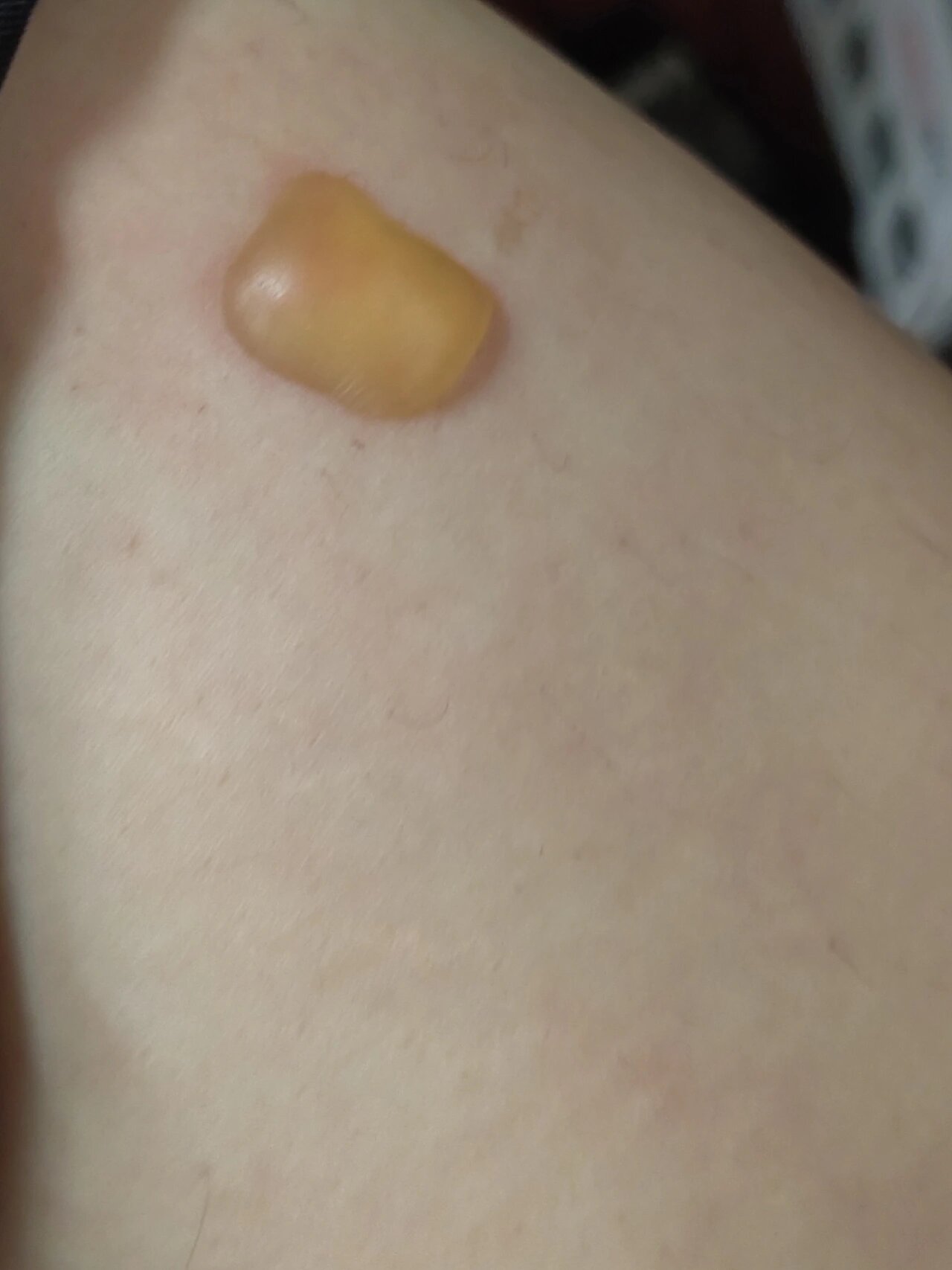 我也出灸花了😓😓😓 这个给我感觉根本不是灸花就是烫伤了但是