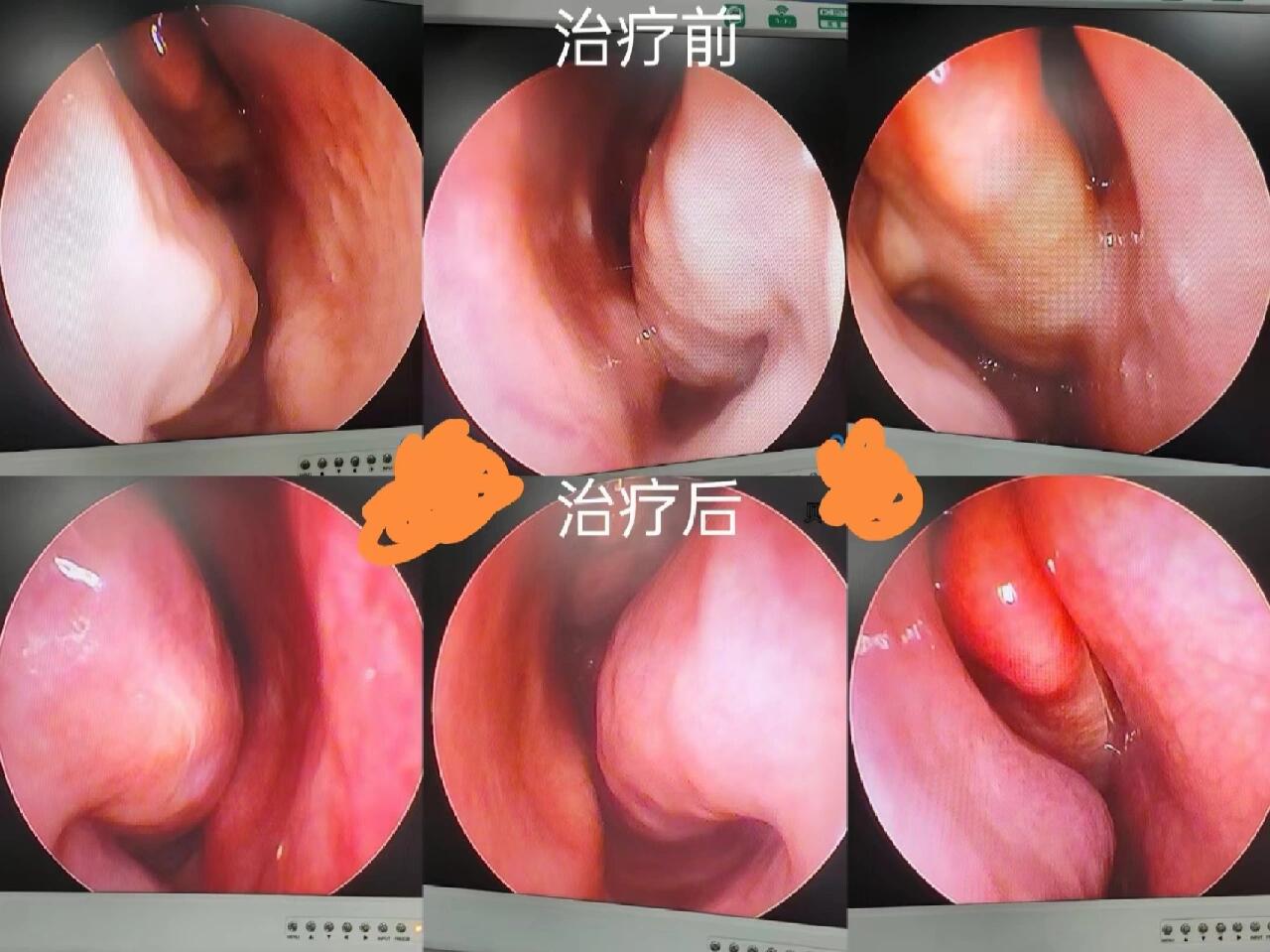 过敏性鼻炎鼻腔镜图片图片