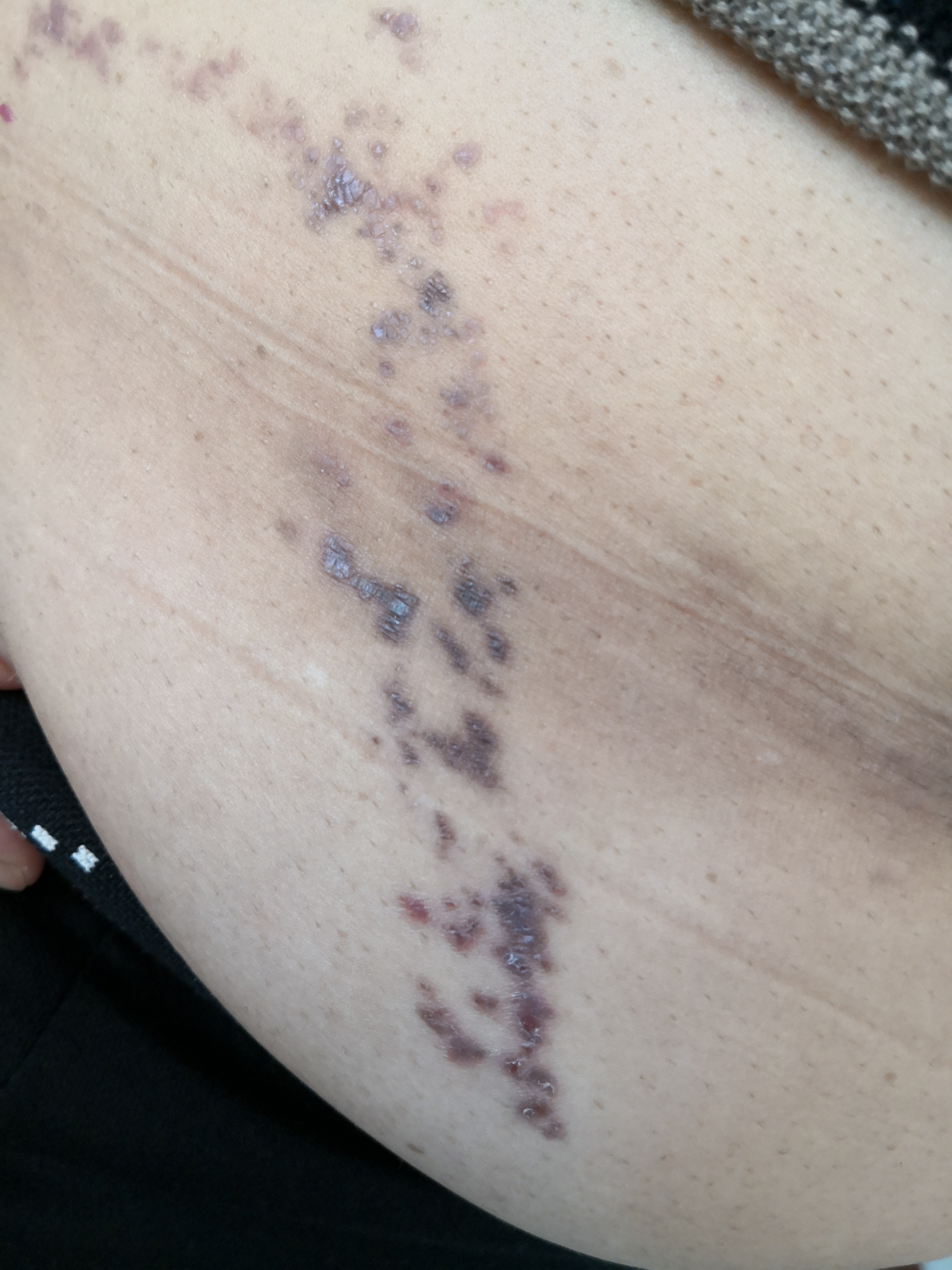 右侧腰部的线状苔藓样.@纪秀军皮肤科主任医师的动态