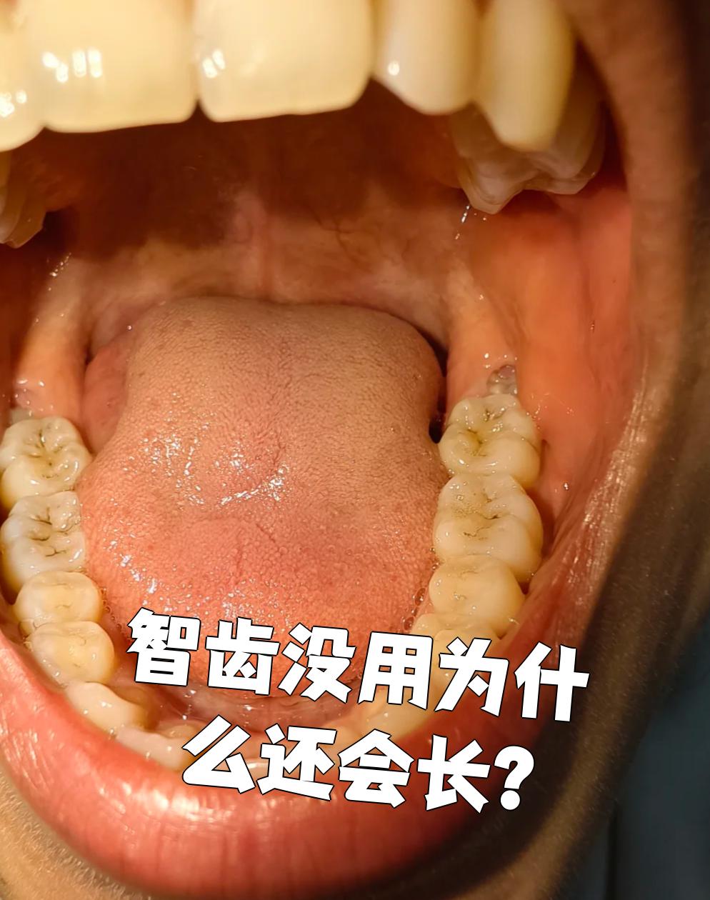 智齿是人类进化过程中留下的退化器官,有些人完全退化就不会长