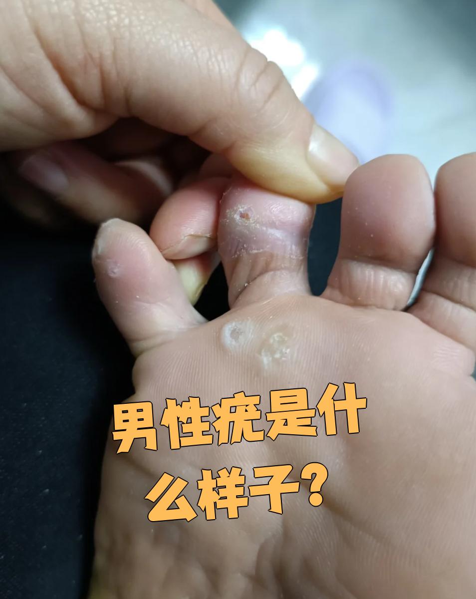 男性疣通常是人乳头瘤病毒(hpv)感染引起的皮肤凸起物,颜色可能是