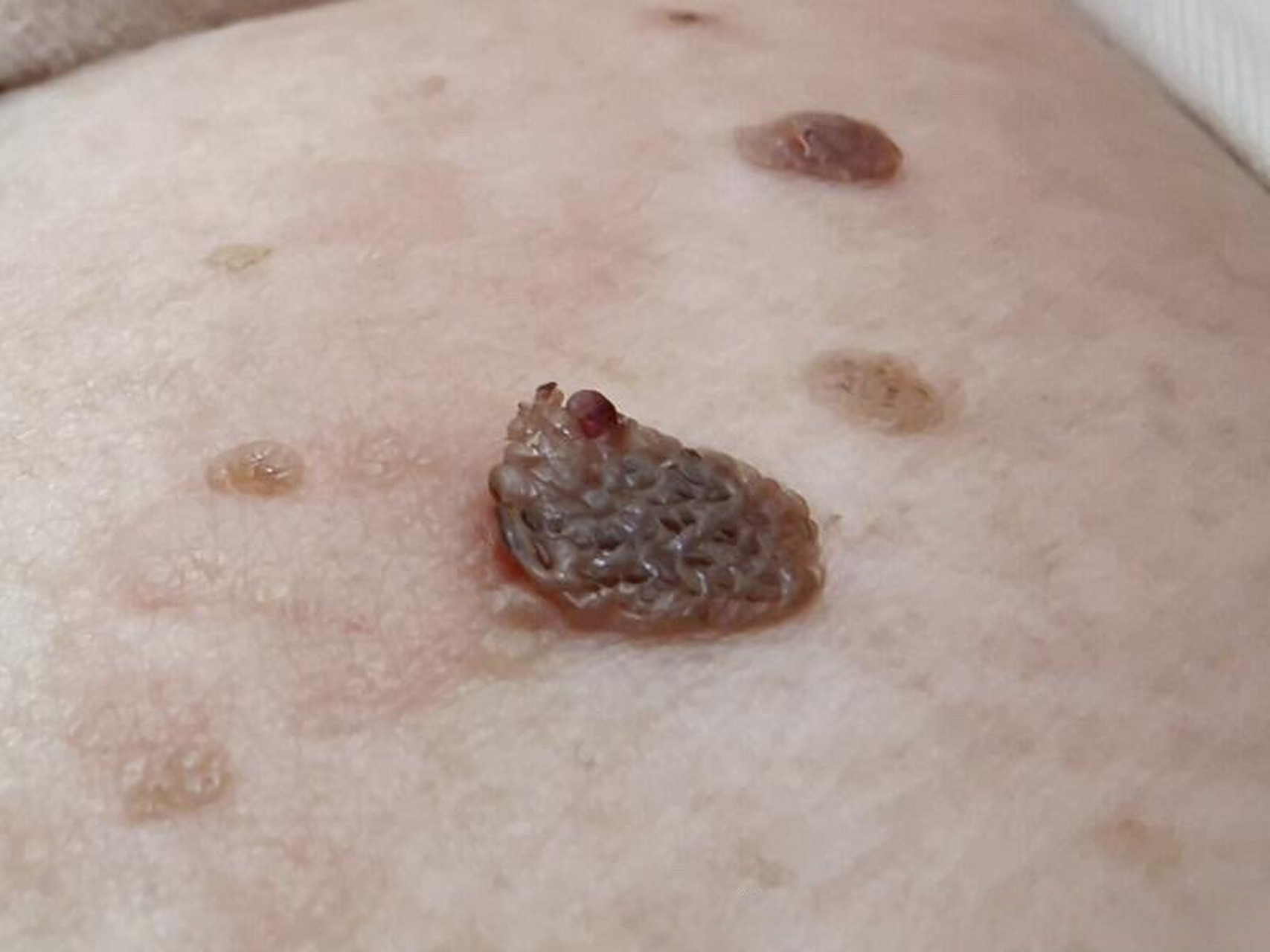 胸部上长了一个不知道是疣还是痣?