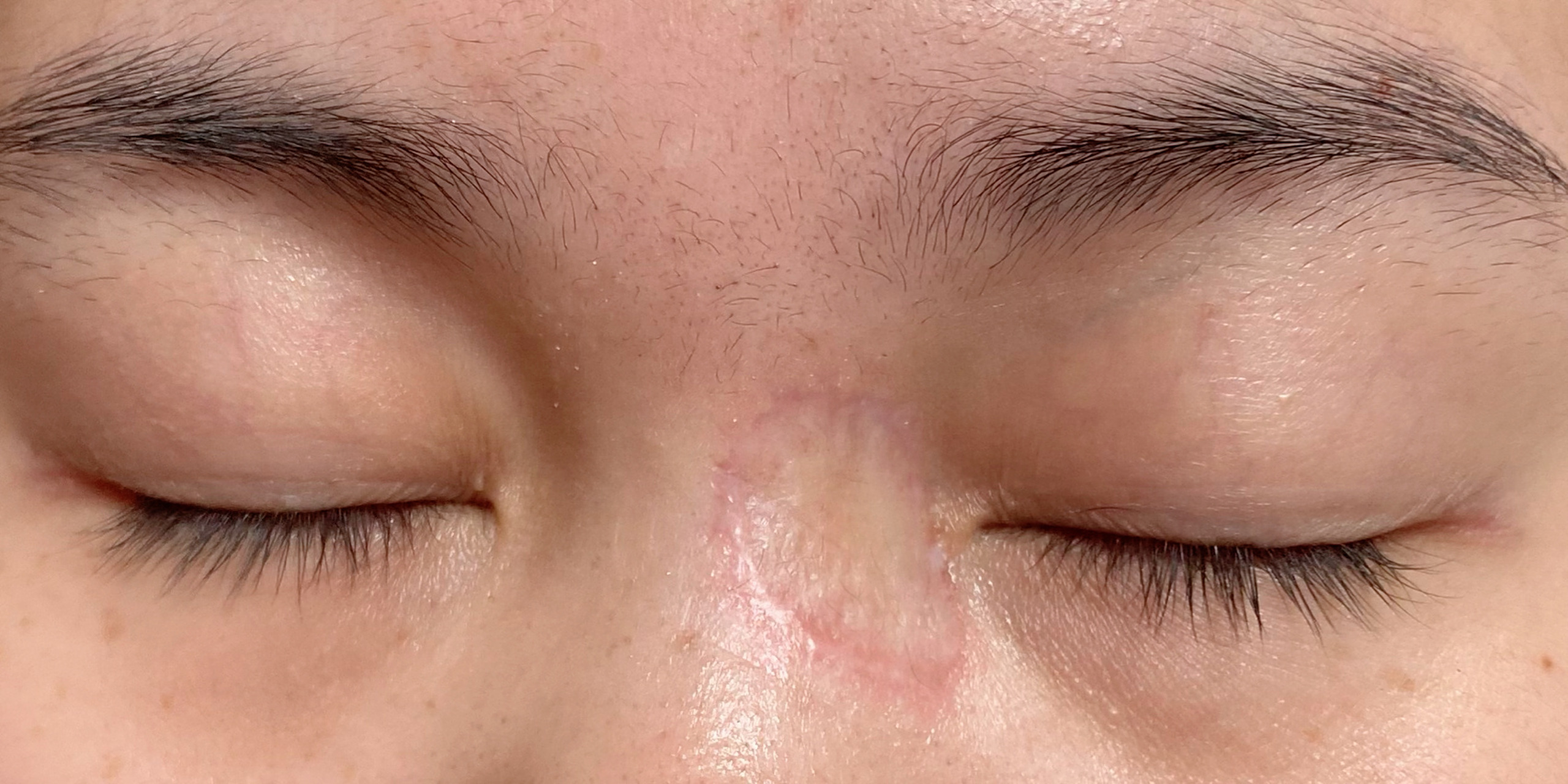 胎记二次切除 植皮,已经五个多月了 目前的状态算是慢慢稳定下来了