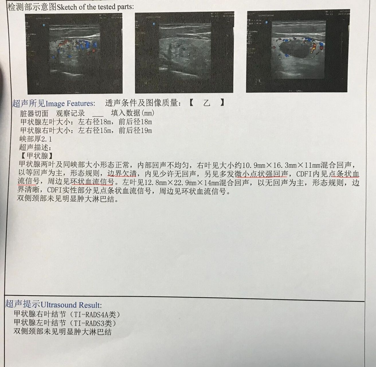 甲状腺结节彗星尾图片