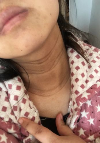 产后脖子上的黑色素怎么去掉?