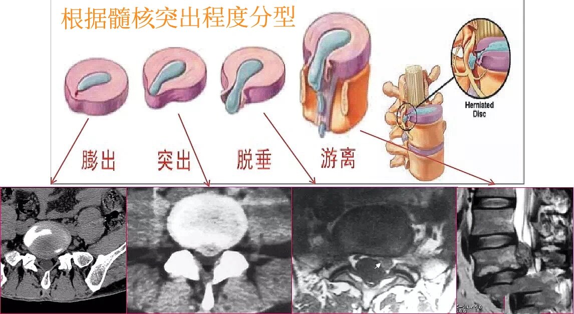 腰髓部位示意图图片