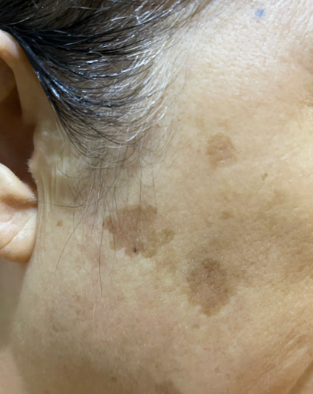 老年斑也叫脂溢性角化病,主要和年龄增长,紫外线照射有关