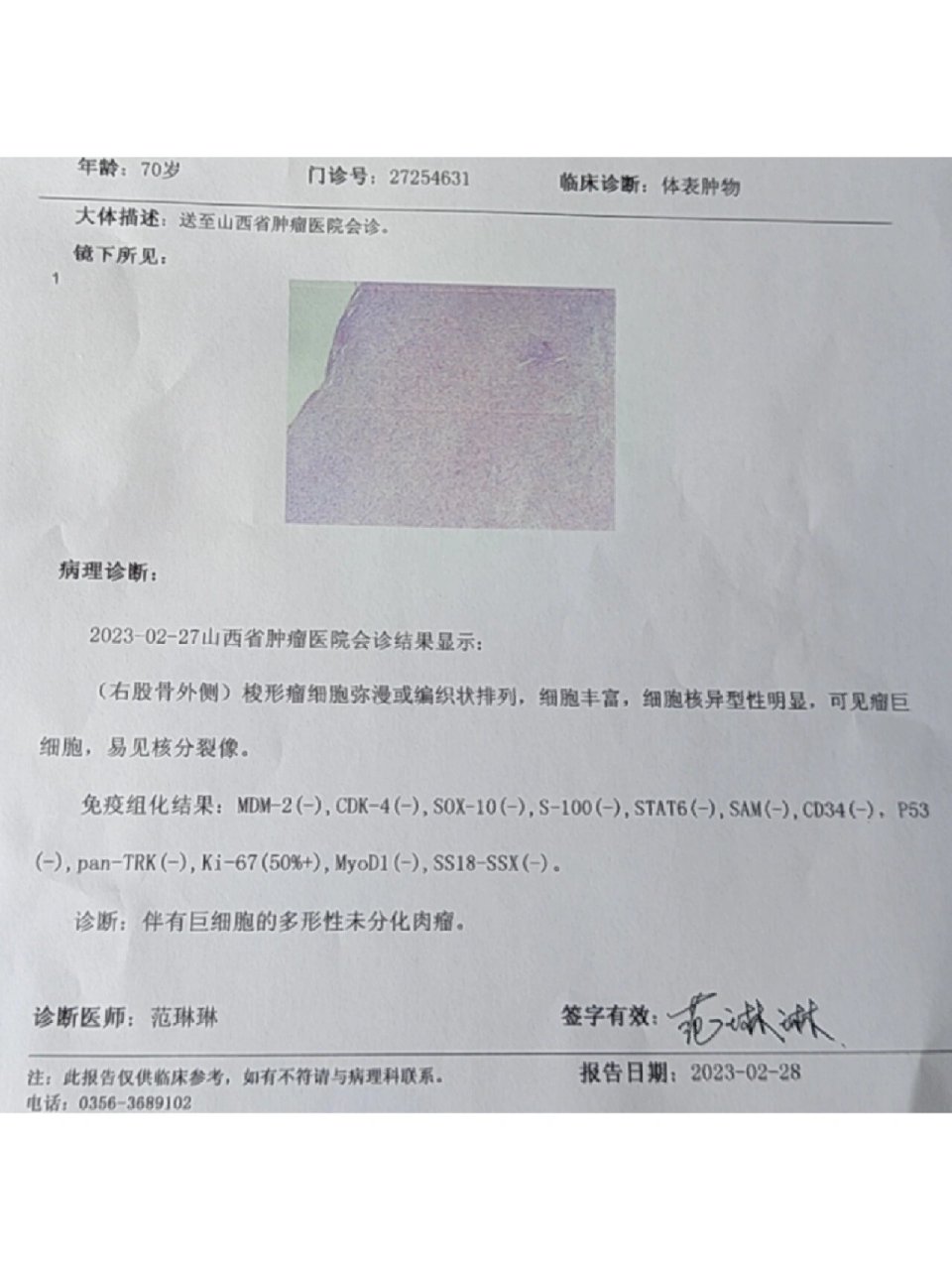 多形性未分化肉瘤 去年年底,奶奶膝盖外侧有个小肿物动了手术,切掉了
