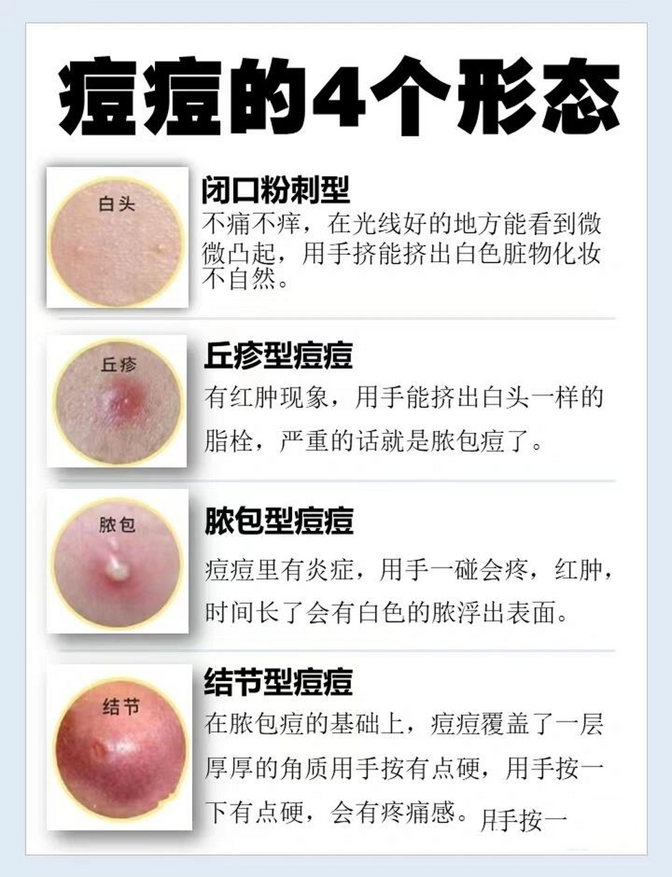 一篇看懂痘痘的4个形态🔥 痘痘生长过程的4个形态: ①门闭口粉刺型