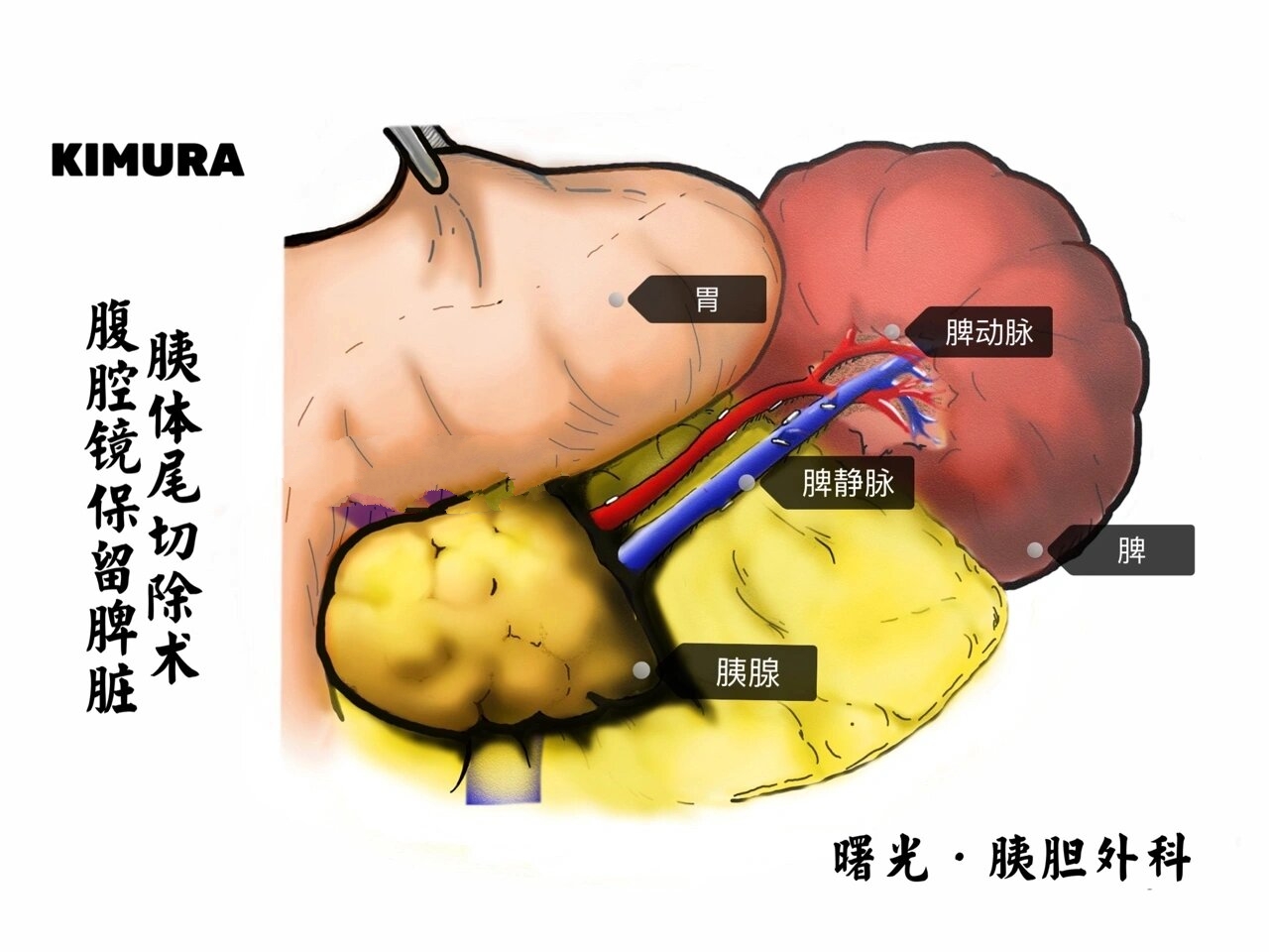 kimura(腹腔镜下保留脾脏的胰体尾切除术)