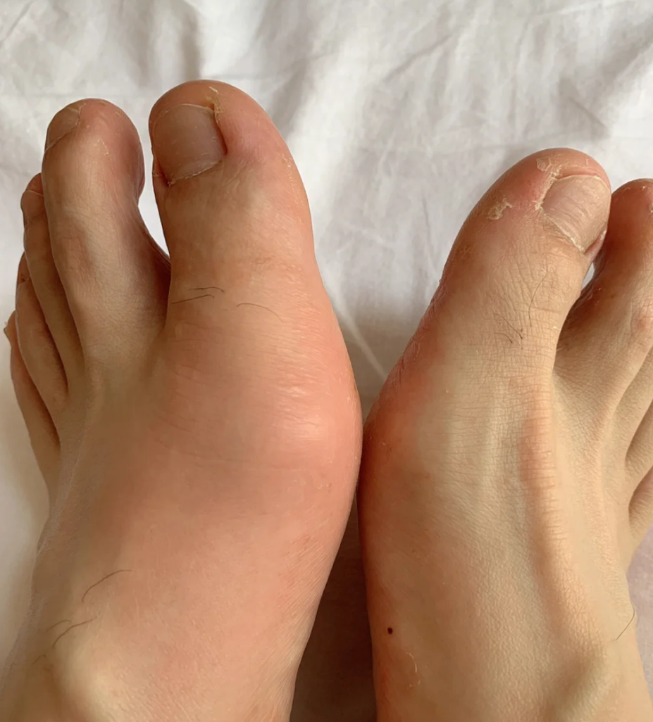 如果脚趾或脚背出现红肿,发热,疼痛,不管血尿酸高不高,只要在痛风石