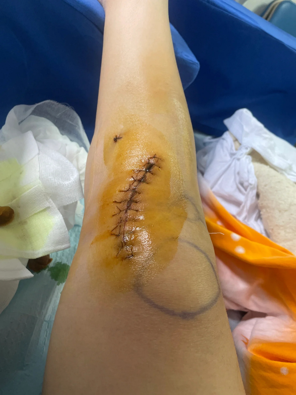 天 第十三天了,最近伤口不动它就没什么感觉,右腿伤口没左边恢复得好