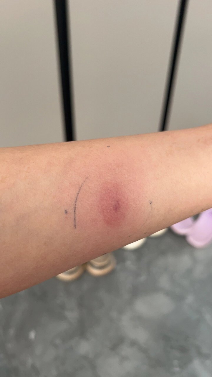 ppd阳性 担惊受怕了72个小时后,去医院查看结果,没跑了,是阳性.