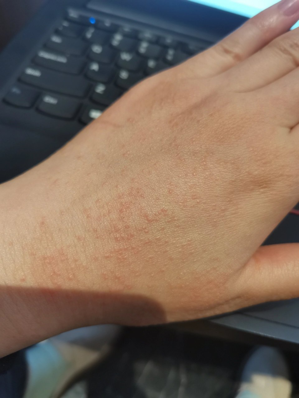 手背突然长了很多小疙瘩 还发红 这是什么疹子呀   怎么会突然这样