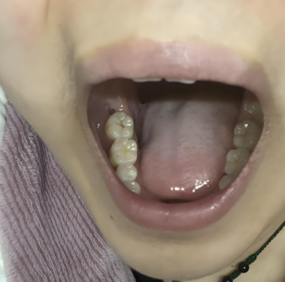 智齿就是第三磨牙