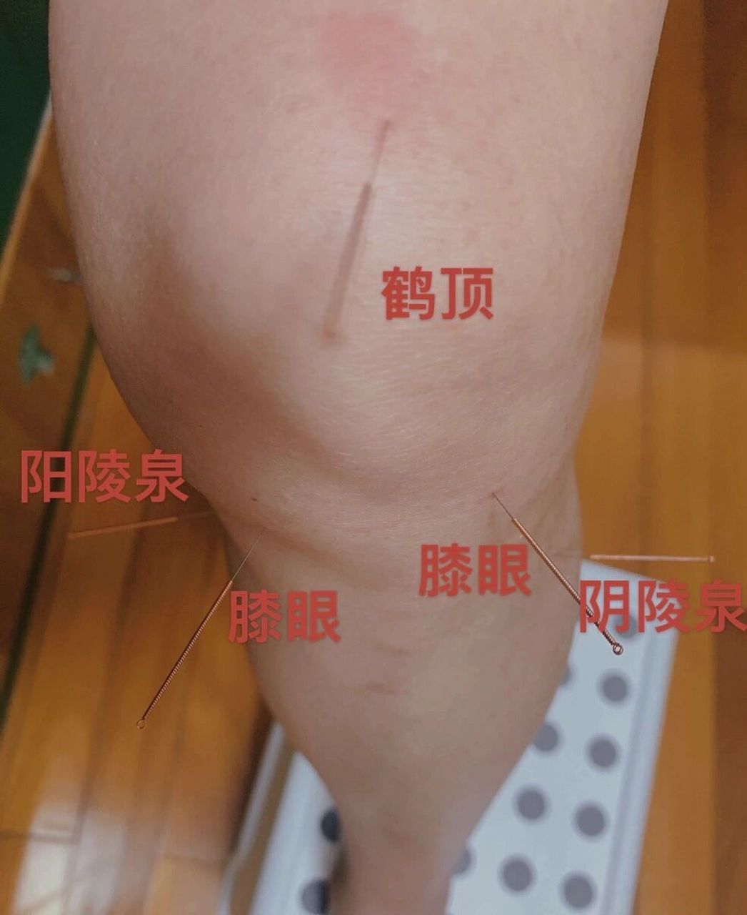膝关节针灸位置图片图片