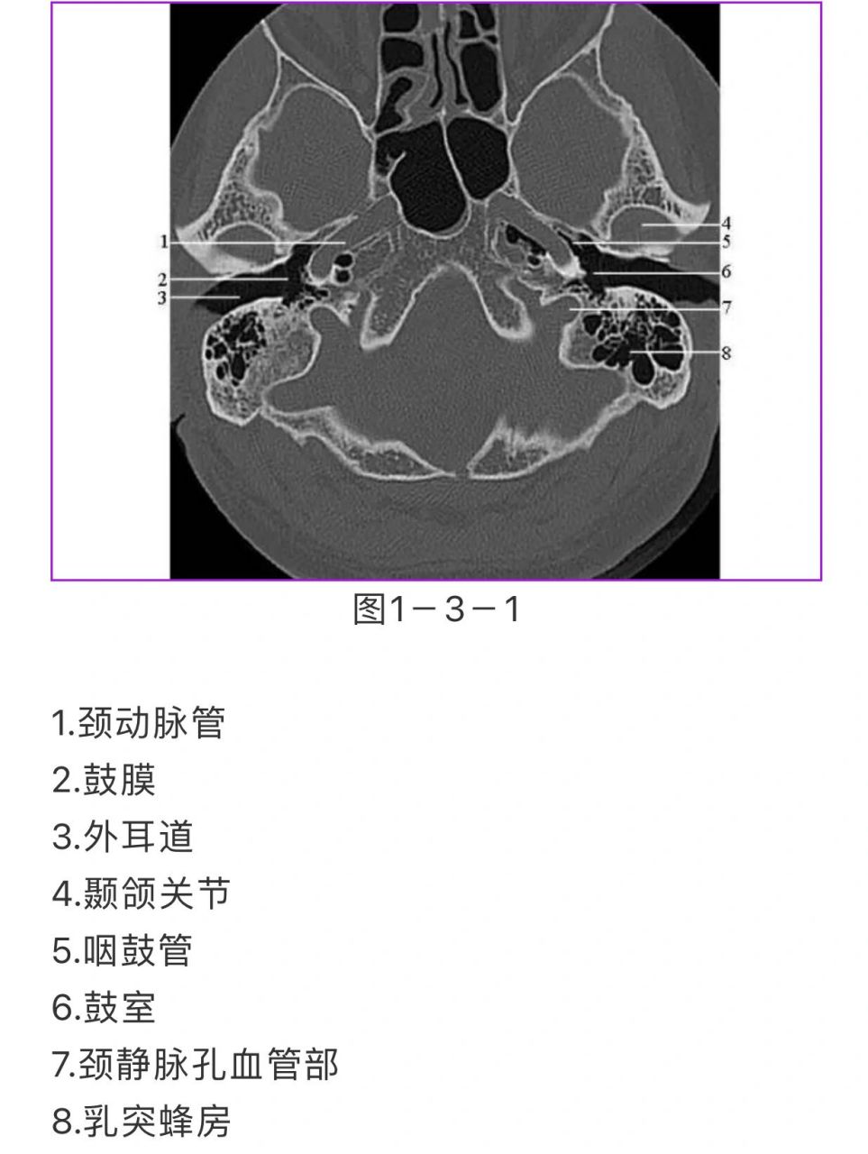 颞骨正常CT解剖图片