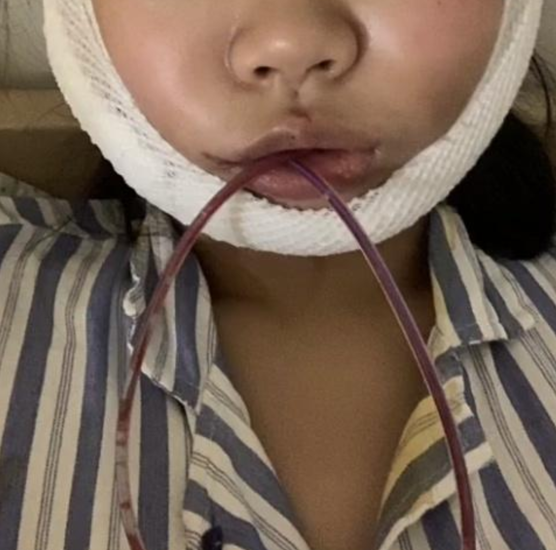 下颌骨骨折的临床表现主要有以下几点: