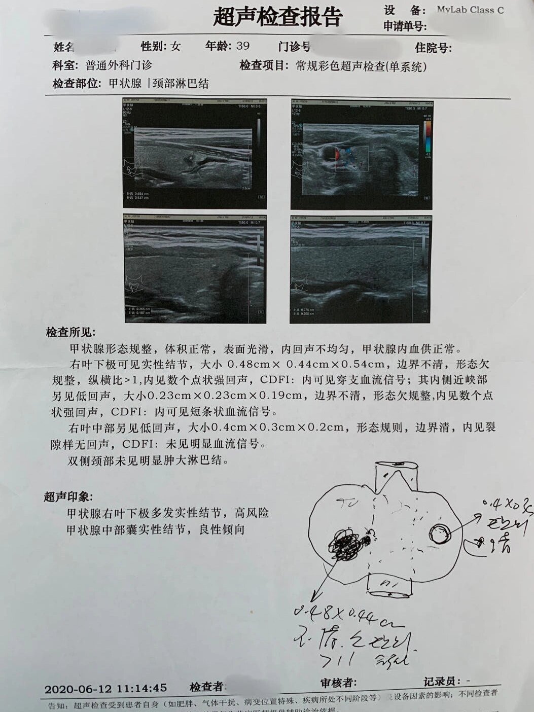 桥本氏甲状腺炎伴甲亢8年反复复发